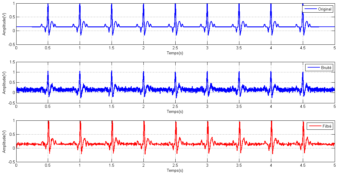 signal ecg filtré